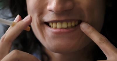 Smoking and Dental Health Problem - White Zone Best Dental Clinic in Kolkata